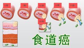 尿道畸形我們要怎樣預防？