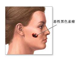 附睪炎是怎么引起的