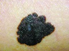 附睪炎有哪些征兆?